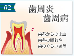 02 歯周炎・歯周病