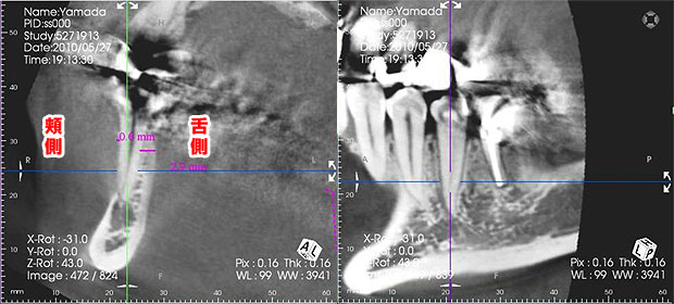 (4)歯周病治療　CT写真