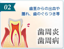 02 歯周炎　歯周病